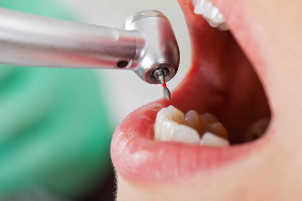 Best Emergency Dentist for Lost Fillings or Crowns in Mcgovern, PA